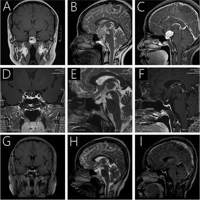 Case Report: Sellar Ependymomas: A Clinic-Pathological Study and Literature Review